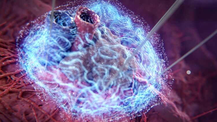 tumor-environment-nanoknife.jpg